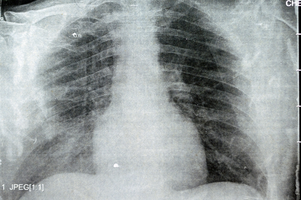 Hospital-acquired infections fall from 2015-2023